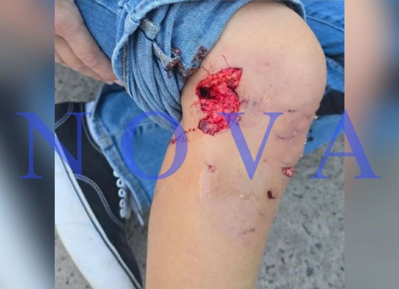 Casi terminó en tragedia: una mujer sufrió el ataque de un perro suelto en Gonnet